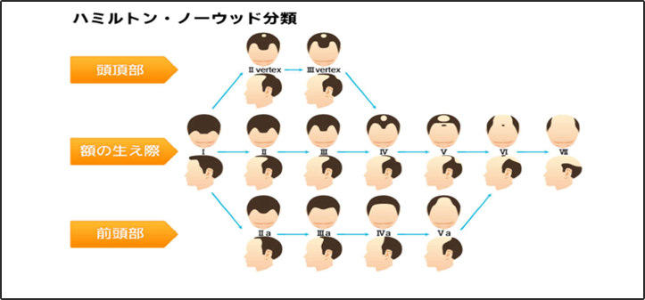 薄毛に関する意識調査