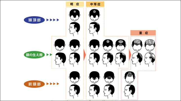 脱毛の進行の図
