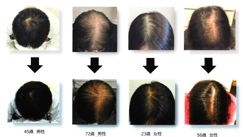 発毛する目安の期間